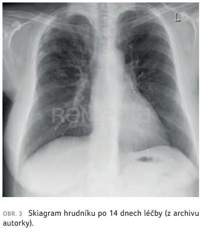 Zkušenosti s biologickou léčbou u eozinofilní granulomatózy s polyangiitidou