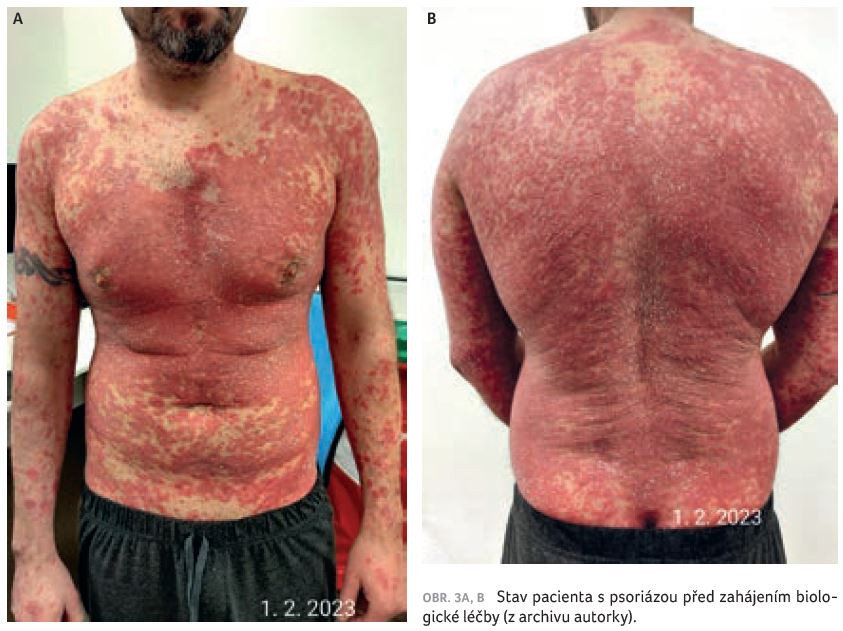 OBR. 3A, B Stav pacienta s psoriázou před zahájením biologické léčby (z archivu autorky).