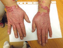 OBR. 1 Rozsáhlá psoriatická ložiska na rukou před změnou léčby na guselkumab v květnu 2019 (z archivu prof. Gkalpakiotise).