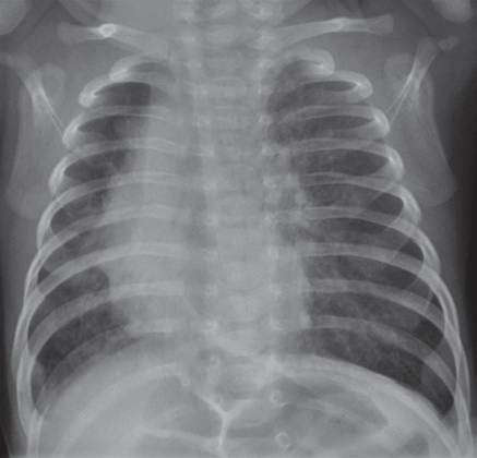 OBR. 1 RTG plic při přijetí pacienta s nálezem pneumonitidy (z archivu Kliniky radiologie a nukleární medicíny FN Brno).