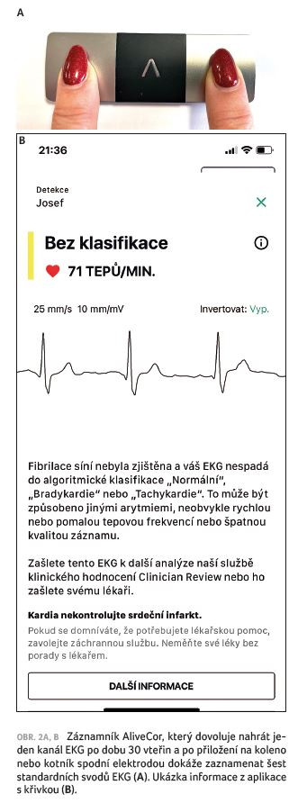OBR. 2A, B Záznamník AliveCor, který dovoluje nahrát jeden kanál EKG po dobu 30 vteřin a po přiložení na koleno nebo kotník spodní elektrodou dokáže zaznamenat šest standardních svodů EKG (A). Ukázka informace z aplikace s křivkou (B).