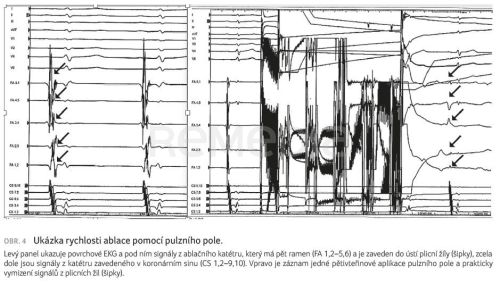 Arteriální hypertenze a fibrilace síní – zločinné spolčení