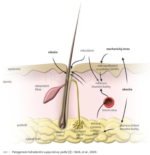 Hidradenitis suppurativa