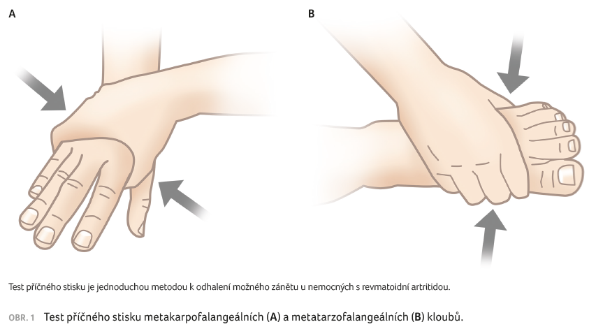 OBR. 1 Test příčného stisku metakarpofalangeálních (A) a metatarzofalangeálních (B) kloubů