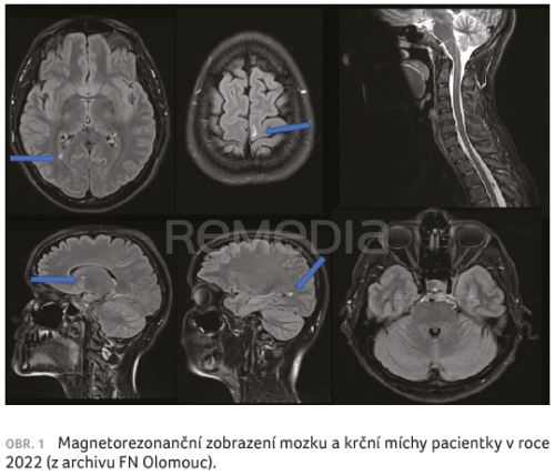 HET subkutánním ofatumumabem u léčebně naivní pacientky s roztroušenou sklerózou