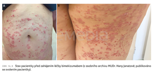 Jak se bimekizumab osvědčuje v reálné praxi