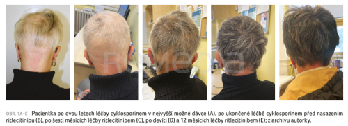 Možnosti léčby alopecia areata