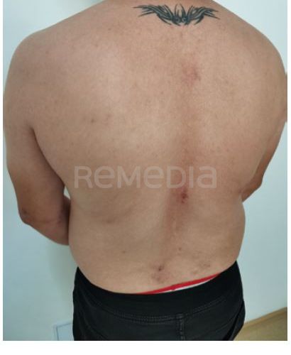 Pacient s těžkou atopickou dermatitidou a Leidenskou mutací léčený abrocitinibem