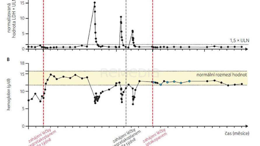 Úspěšný přechod z pegcetakoplanu na iptakopan po opakovaných závažných průlomových hemolýzách – kazuistika