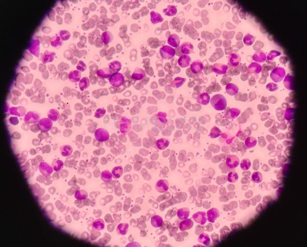Asciminib je silným inhibitorem ABL/BCR::ABL1 tyrozinkinázy. Inhibuje aktivitu kinázy ABL1 fúzního proteinu specifickým zacílením na ABL myristoylovou kapsu. Přípravek byl registrován pro terapii dospělých pacientů s Philadelphia chromozom pozitivní chron