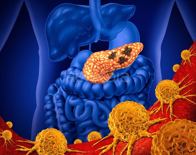 Daraxonrasib – přelom v terapii karcinomu pankreatu