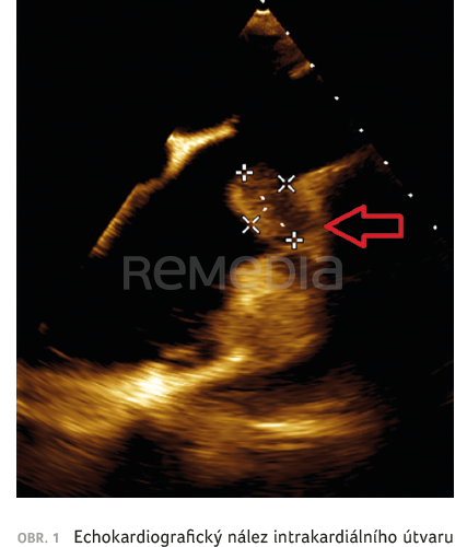 Pacienti s útvarem v srdeční dutině: jak postupovat? Kazuistiky
