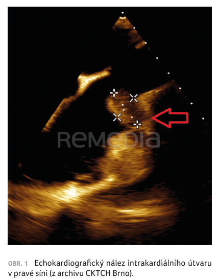 Pacienti s útvarem v srdeční dutině: jak postupovat? Kazuistiky