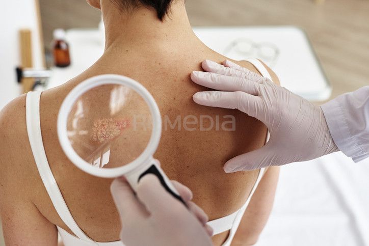 Bimekizumab nově hrazen pro léčbu hidradenitis suppurativa