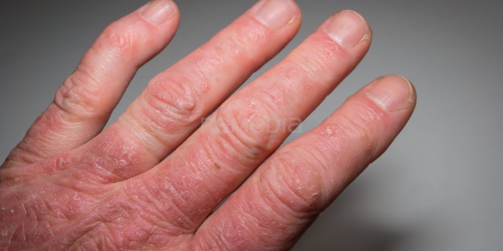Psoriatická artritida léčená infliximabem s opětovným dosažením remise při podkožní aplikaci