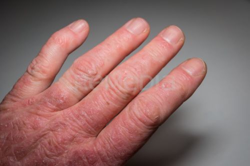 Psoriatická artritida léčená infliximabem s opětovným dosažením remise při podkožní aplikaci