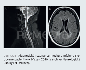 Siponimod v terapii časné sekundární progrese roztroušené sklerózy