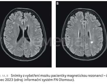 Snímky z vyšetření mozku pacientky magnetickou rezonancí