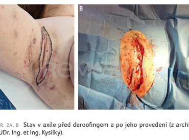 Stav v axile před deroofingem a po jeho provedení